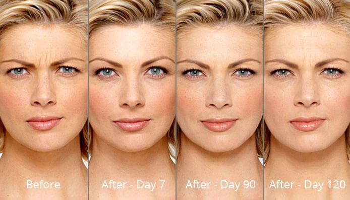 Botox cosmetic treatment in Canyon Lake and Riverside, CA