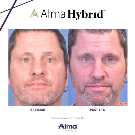 man with clear skin form Alma Hybrid treatment